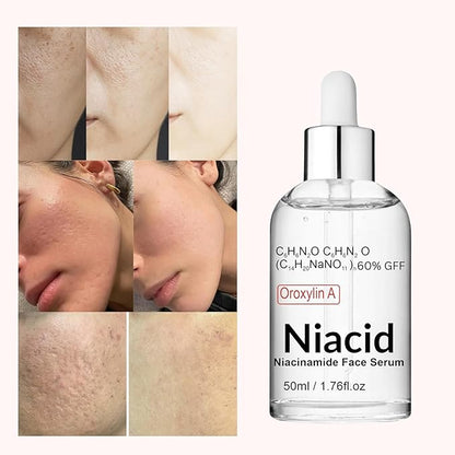 Nuevo NIACID®: Elimina manchas y cicatrices de acné en solo 4 semanas