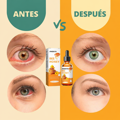 Nuevo Bee Honey ®: Recupera la claridad de tu mirada y elimina la carnosidad sin cirugías en solo 3 semanas