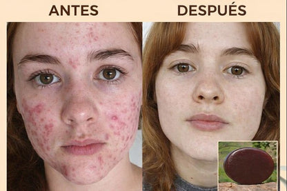 Nuevo Jabón de Sangre de Grado®: Elimina el acné y borra las cicatrices de tu rostro en tiempo récord.