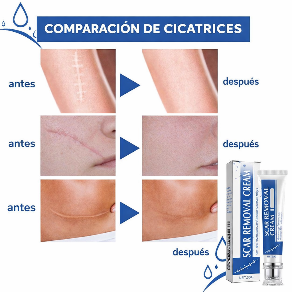 Nueva Crema Scar Removal®: Borra tus cicatrices y recupera la suavidad de tu piel en solo 14 días